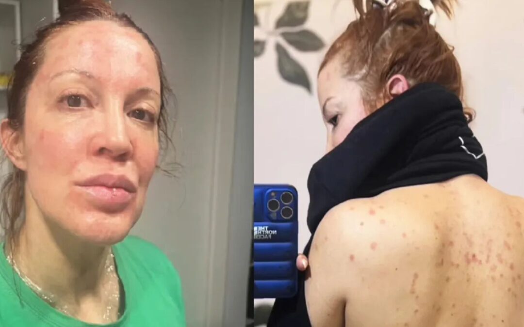 Miriam Lanzoni habló de su drama de salud y mostró impactantes fotos: “Me dolía mirarme”