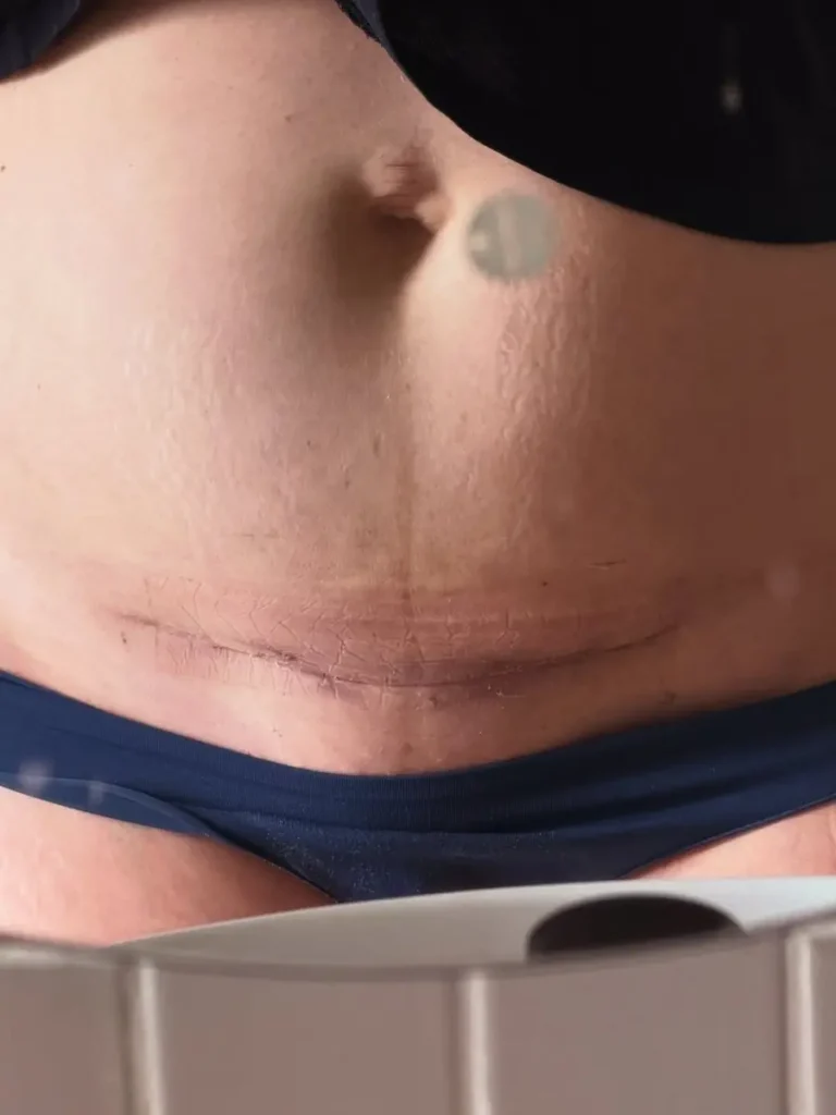 Juana Repetto cesárea