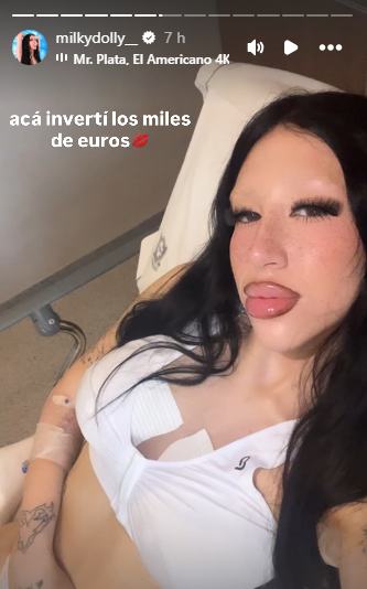 Milky Dolly y su historia de Instagram tras la operación